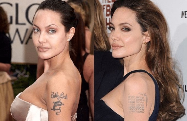 permanent tattoo removal