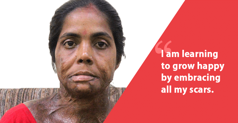 Acid Attack Survivor