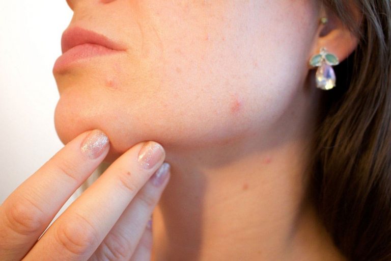 Zap Those Zits By Properly Using An Acne Patch